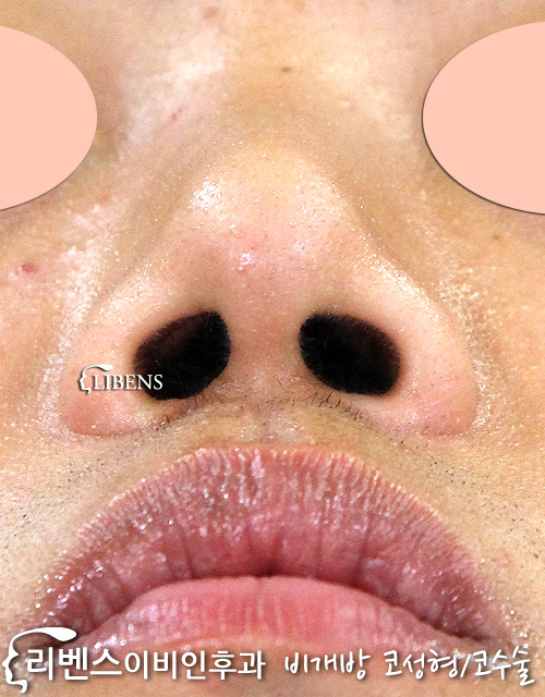 눌린 콧구멍 낮은 코끝 성형 수술 높이기 비중격 연골 삽입 무보형물 성형 s597